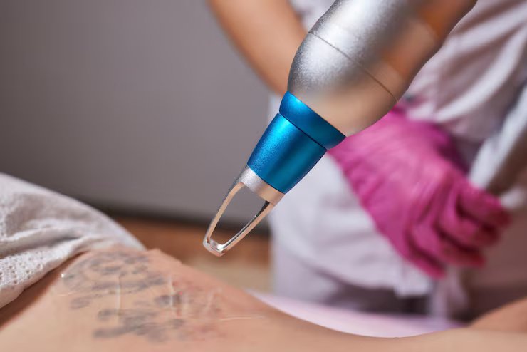Tattoo Removal