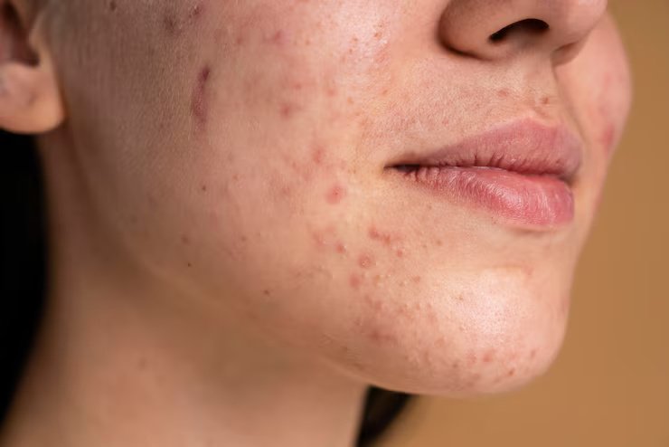 Acne Scar Treatment